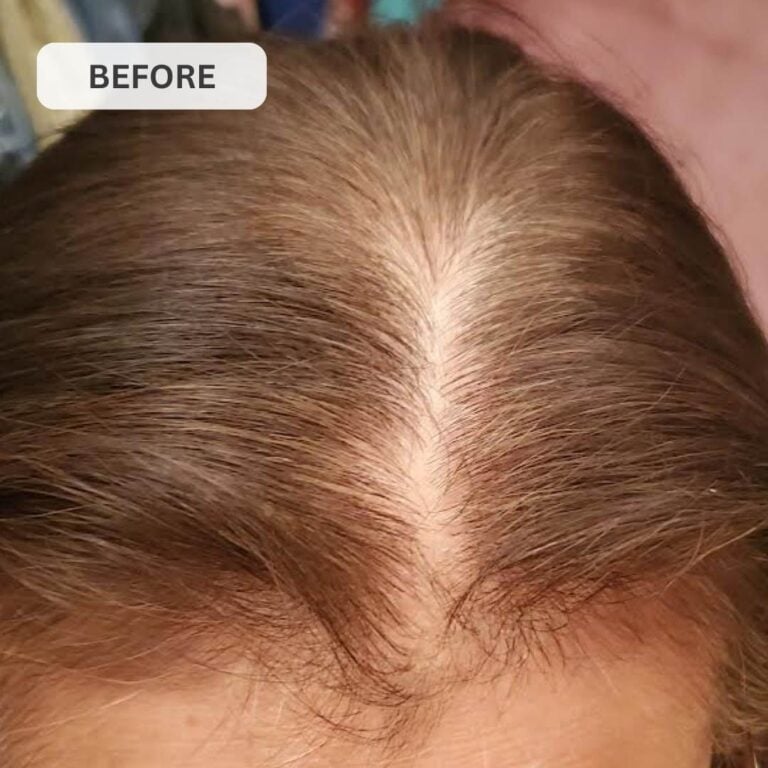 Regrow Your Hair & Restore Your Hairline in Under 30 Days with GLUTERA's Laser Cap