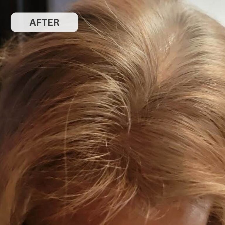 Regrow Your Hair & Restore Your Hairline in Under 30 Days with GLUTERA's Laser Cap