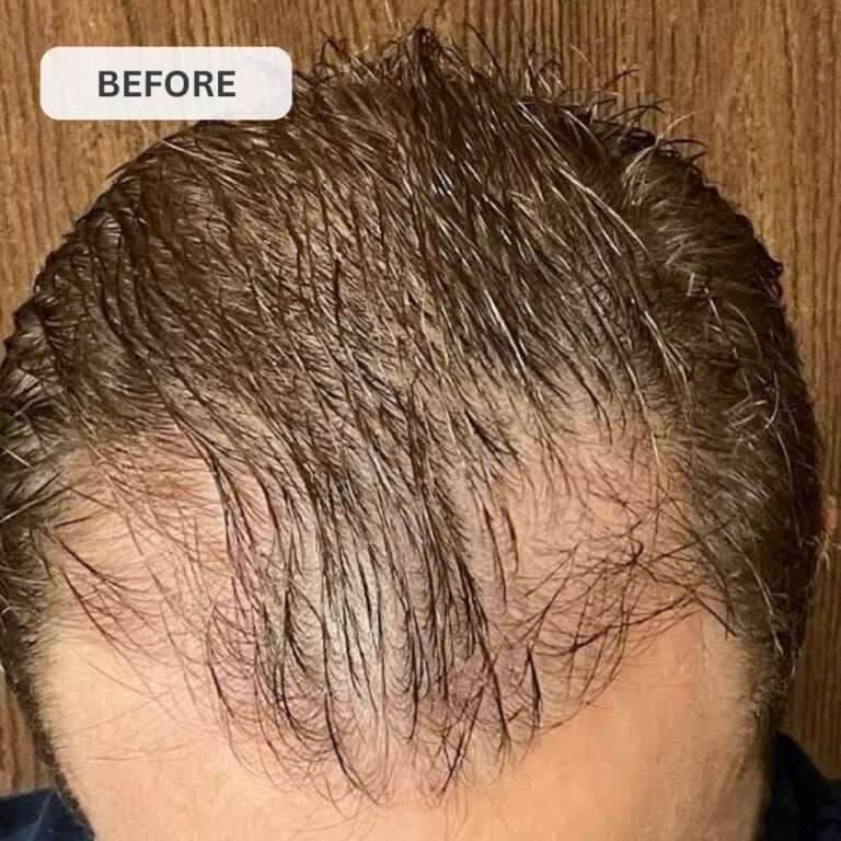 Regrow Your Hair & Restore Your Hairline in Under 30 Days with GLUTERA's Laser Cap