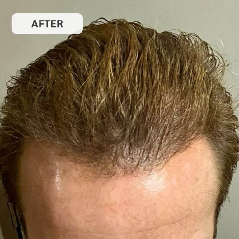 Regrow Your Hair & Restore Your Hairline in Under 30 Days with GLUTERA's Laser Cap