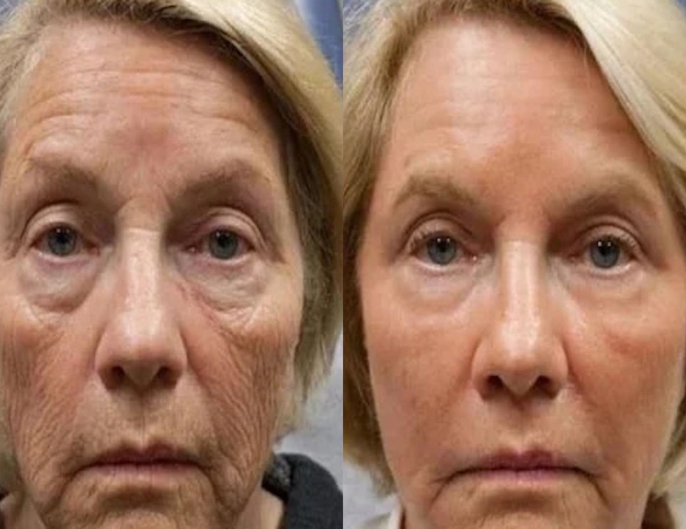 Get Rid of wrinkles,Look younger in 30 days with our Anti-aging solution