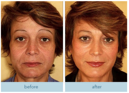 Get Rid of wrinkles,Look younger in 30 days with our Anti-aging solution