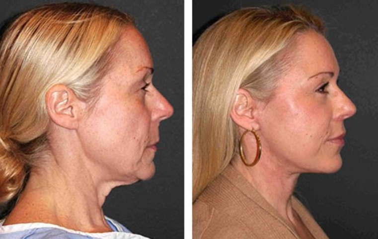 Get Rid of wrinkles,Look younger in 30 days with our Anti-aging solution