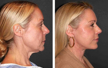 Get Rid of wrinkles,Look younger in 30 days with our Anti-aging solution