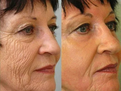 Get Rid of wrinkles,Look younger in 30 days with our Anti-aging solution